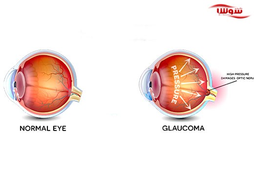 گلوکوم | آب سیاه چشم (Glaucoma)