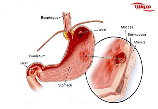 زخم های گوارشی (Peptic ulcer)