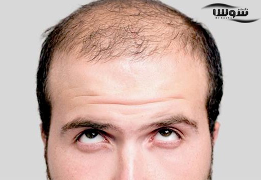 دارو های ضد ریزش مو میتوانند مشکلات جنسی بوجود بیاورند؟
