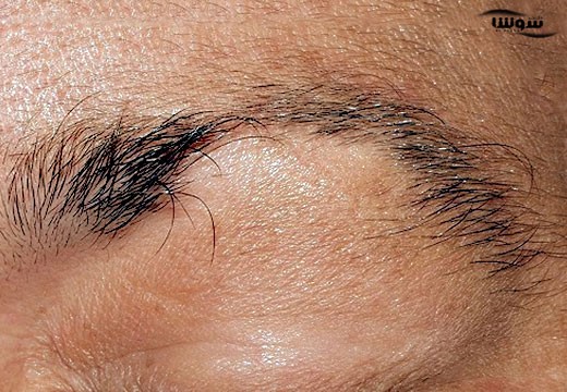 ریزش مژه و ابرو را چگونه درمان کنیم