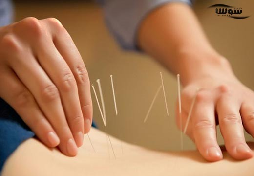 طب سوزنی برای لاغری