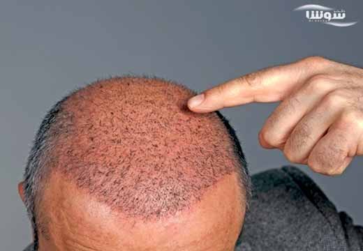 کاشت مو با سلولهای بنیادی