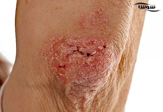 پسوریازیس (Psoriasis)