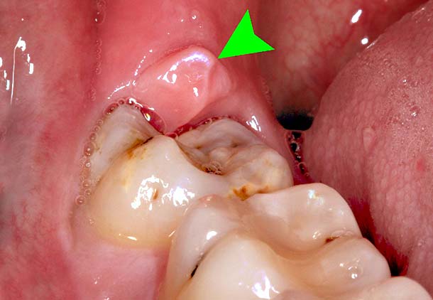 عفونت دندان عقل نيمه نهفته چيست ؟