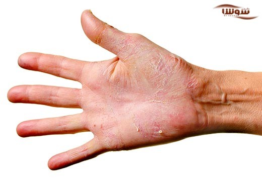 درماتیت (Dermatitis)