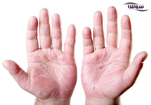 خشکی پوست دست نشانه چیست؟
