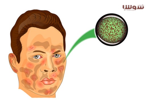 جذام | هانسن | ( Leprosy | Hansen )