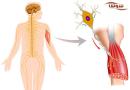 ALS | اسکلروزیس آمیوتروفیک جانبی | Amyotrophic lateral sclerosis