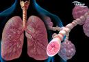 آسم (Asthma)