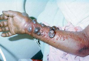 عوامل خطر یا ریسک فاکتورها در بیماری ابولا