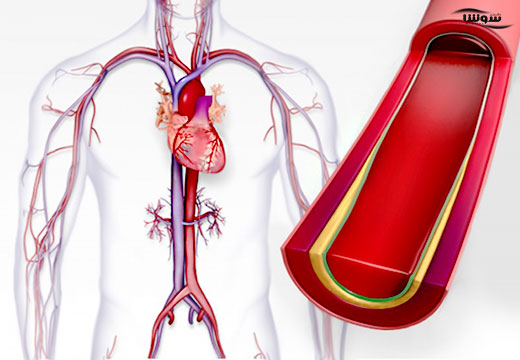 فشار خون بالا | هیپرتانسیون (Hypertension) فشار خون بالا | هیپرتانسیون (Hypertension)