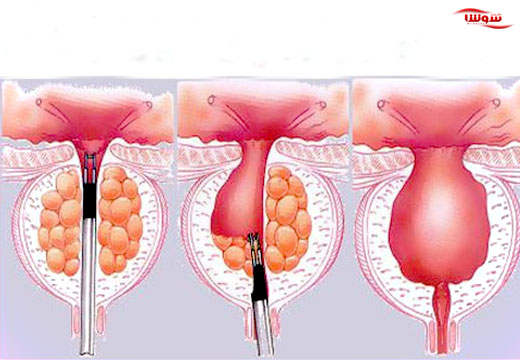 هایپرپلازی خوش خیم پروستات (Benign prostatic hyperplasia) هایپرپلازی خوش خیم پروستات (Benign prostatic hyperplasia)