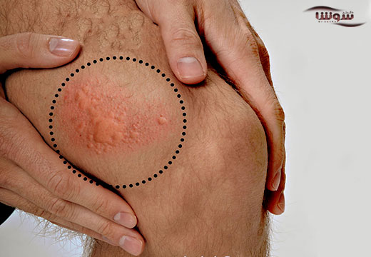 کهیر  (Hives and angioedema)