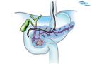 کیست پانکراس  (Pancreatic cysts)