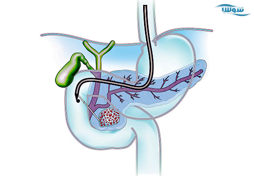 کیست پانکراس (Pancreatic cysts) کیست پانکراس (Pancreatic cysts)