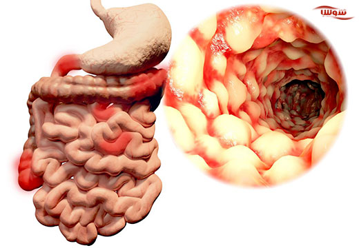 بیماری التهابی روده | کرون (Crohns) بیماری التهابی روده | کرون (Crohns)