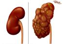 نارسایی مزمن کلیوی (Chronic renal failure)