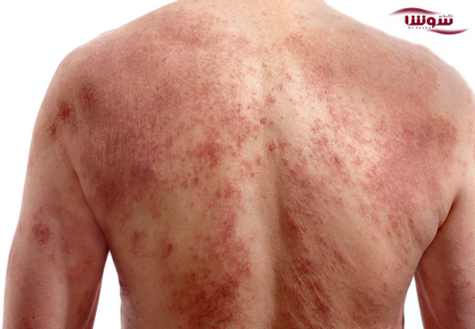 سرطان پوست (skin cancer) سرطان پوست (skin cancer)