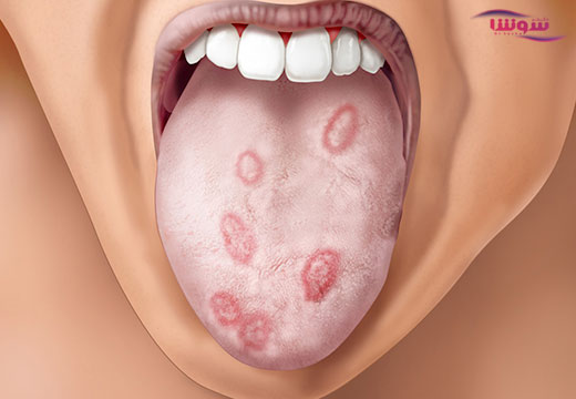 سیفلیس (syphilis) سیفلیس (syphilis)