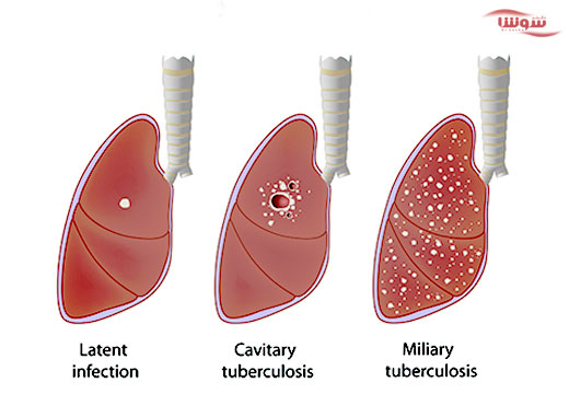 سل | (Tuberculosis (TB سل | (Tuberculosis (TB