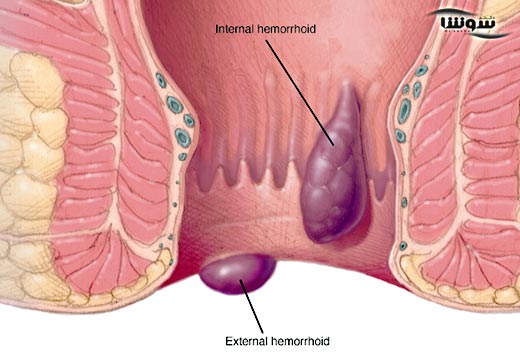 بواسیر | هموروئید ( Hemorrhoids ) بواسیر | هموروئید ( Hemorrhoids )