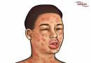 آنافیلاکسی  (anaphylaxis)