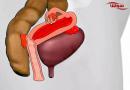 اندومتریوز (endometriosis)