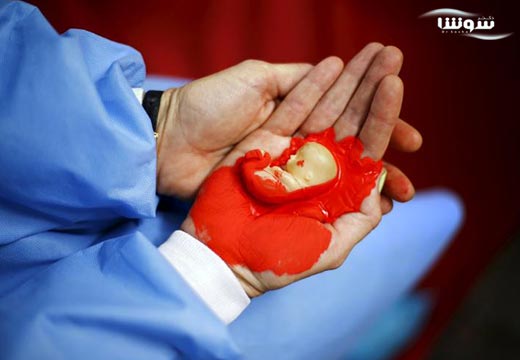 افسردگی بعد از سقط جنین عمدی؛ یا غیر عمدی افسردگی بعد از سقط جنین عمدی؛ یا غیر عمدی