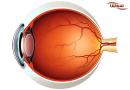 پیر چشمی (Presbyopia)