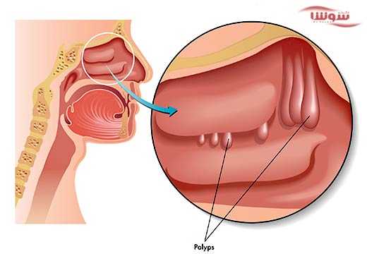 پولیپ بینی (Nasal polyps) پولیپ بینی (Nasal polyps)