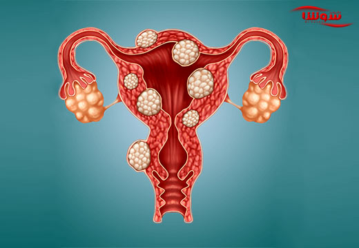 فیبروئیدهای رحم (Uterine fibroids) فیبروئیدهای رحم (Uterine fibroids)