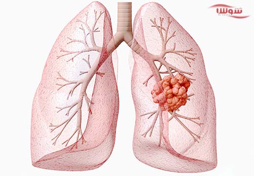 سرطان ریه (Lung Cancer) سرطان ریه (Lung Cancer)