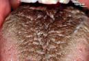 زبان مودار سياه (black Hairy Tongue)
