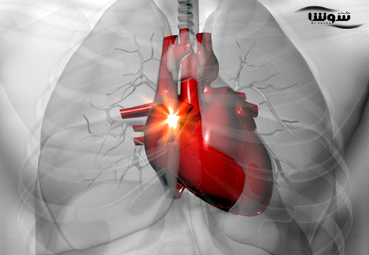 تپش قلب (heart palpitations) تپش قلب (heart palpitations)