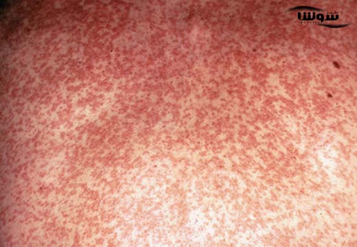 سرخک (rubella) سرخک (rubella)