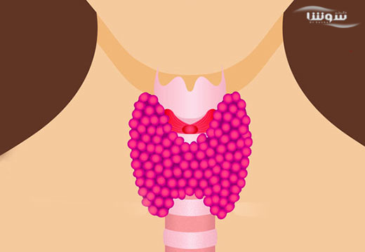 تیروئیدیت تحت حاد (Subacute thyroiditis) تیروئیدیت تحت حاد (Subacute thyroiditis)