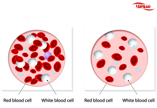 نقص ایمنی متغیر شایع (Common variable immunodeficiency) نقص ایمنی متغیر شایع (Common variable immunodeficiency)