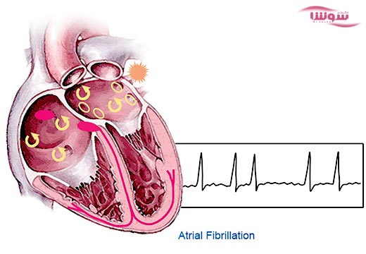 فیبریلاسیون دهلیزی (Atrial fibrillation) فیبریلاسیون دهلیزی (Atrial fibrillation)