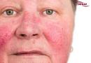 عفونت با ویروس پارو ویروسی   (Parvovirus infection)
