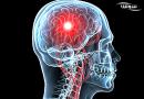 آنسفالیت  (Encephalitis)