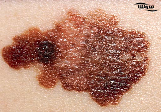 سرطان سلولهای ملانوما پوست (Malignant melanoma) سرطان سلولهای ملانوما پوست (Malignant melanoma)