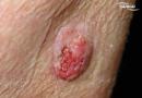 سرطان سلول های سنگفرشی پوست  (Squamous cell carcinoma)