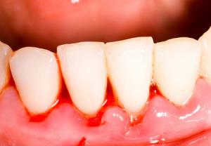 در خطر بودن سلامت دندان با نشانه‌هایی مانند خونریزی ، قرمزی و تورم لثه