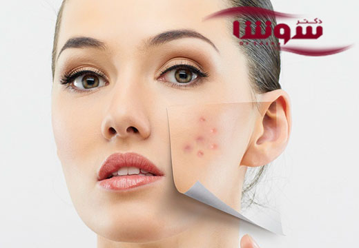 درمان جوش صورت به روش سنتی و طبیعی |بخش اول درمان جوش صورت به روش سنتی و طبیعی |بخش اول