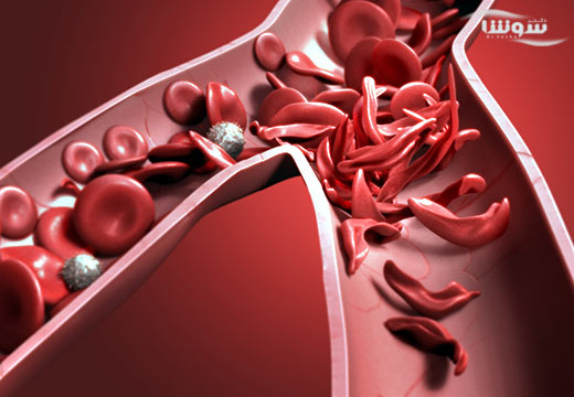 کم خونی داسی شکل (Sickle cell anemia) کم خونی داسی شکل (Sickle cell anemia)