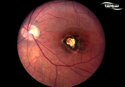 توکسوپلاسموزیس | توکسوپلاسموز (Toxoplasmosis) توکسوپلاسموزیس | توکسوپلاسموز (Toxoplasmosis)