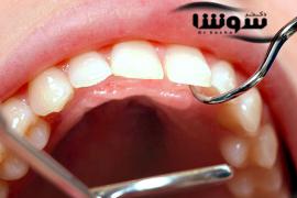 علت قرمزی لثه (ارتباط 4 بیماری با قرمزی و التهاب لثه)