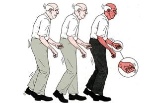 لرزش دست و بدن در بیماری پارکینسون به شکل چرخشی