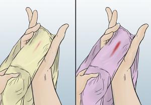 خونریزی شدید در اوایل بارداری