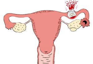 خونریزی شدید در ماه اول بارداری در اثر حاملگی خارج رحمی